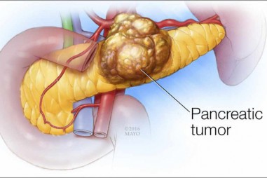 6 dấu hiệu của ung thư tuyến tụy: Căn bệnh cực nguy hiểm vì tỷ lệ sống sót chỉ còn 8,5%