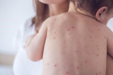 Bệnh đậu mùa giết hàng tỉ người và cách mà y học đánh bại chúng