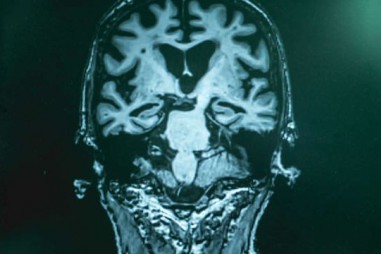 Xét nghiệm máu phát hiện bệnh Alzheimer ở ​​giai đoạn đầu với độ chính xác 94%