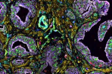 Phát hiện mới khiến tế bào ung thư ‘tự sát’