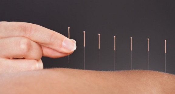 Châm cứu để giảm đau trong y học dựa trên bằng chứng
