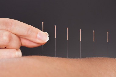 Châm cứu để giảm đau trong y học dựa trên bằng chứng