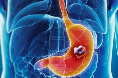 Tăng 68% nguy cơ ung thư dạ dày vì gia vị khó bỏ của người Việt