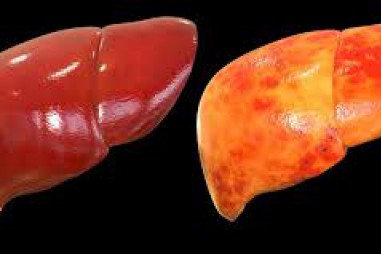 Protein tuổi thọ SIRT6 có tác dụng phòng bệnh gan nhiễm mỡ