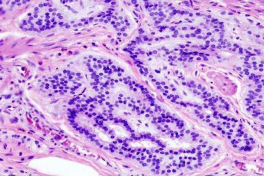 Phát hiện yếu tố bất ngờ liên quan tới 80% trường hợp ung thư ruột