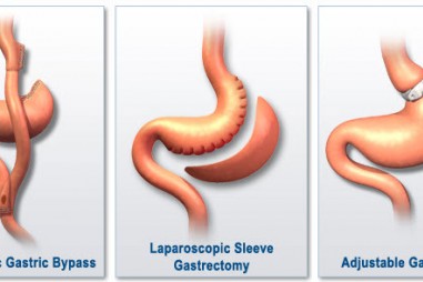 Phẫu thuật barective có thể làm giảm nguy cơ bệnh tim và đột quỵ