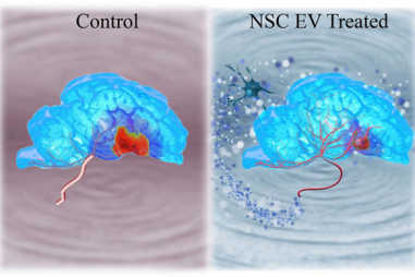 Exosome tiết từ tế bào gốc có thể điều trị đột quỵ