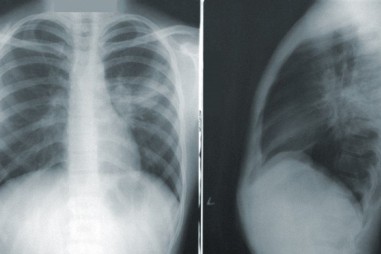 Công bố báo cáo khoa học về COVID-Net, mạng thần kinh nhân tạo có thể phát hiện dấu hiệu Covid-19 trong ảnh X-quang chụp phổi