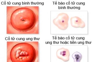 Giấm: Thuốc thử ung thư cổ tử cung