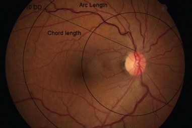 Thuốc nhỏ mắt mới có thể phòng ngừa nguyên nhân phổ biến gây mù lòa.