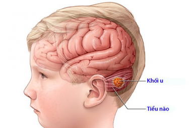 Có thể tái sử dụng thuốc điều trị ung thư bạch cầu Asen để điều trị ung thư não ở trẻ em