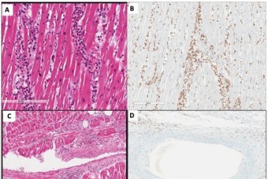 Viêm nội mạc tim và Hội chứng viêm đa hệ sau COVID-19