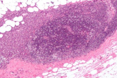 Liệu pháp mới điều trị ung thư vú di căn lên não