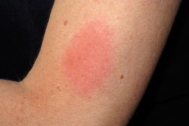 Tác dụng phụ từ vaccine Pfizer, Moderna: đau, sốt nhưng không nguy hiểm