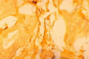 Vắc xin tiềm năng chống vi khuẩn leptospirosis chết người