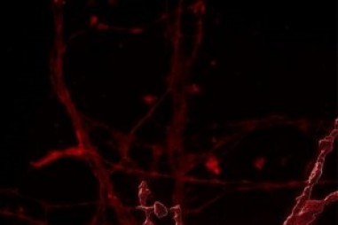 Các nhà nghiên cứu phát hiện não rối trong bệnh Alzheimer