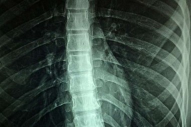 Kích thích tủy sống giúp kiểm soát huyết áp mà không cần thuốc