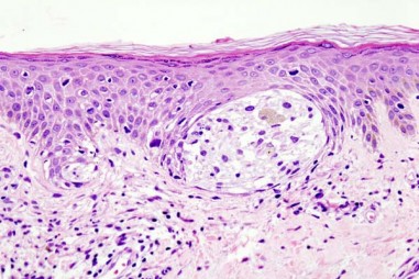 Vắc-xin tạo ra phản ứng chống khối u kéo dài ở bệnh nhân ung thư hắc tố