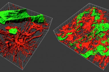 Sinh thiết 3-D để hiểu rõ hơn về khối u não