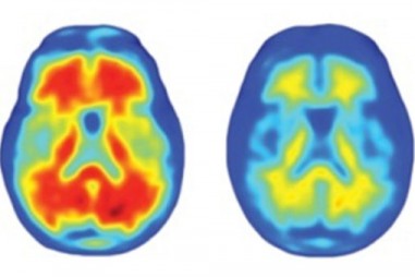 Chẩn đoán sớm bệnh Alzheimer bằng kỹ thuật giải trình tự gen thế hệ mới