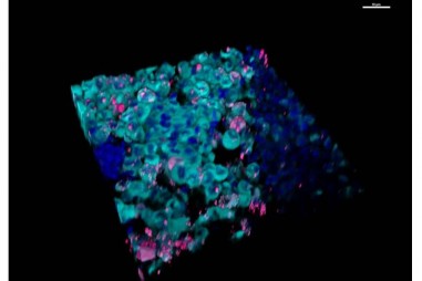 Phát hiện bào quan mới liên quan đến di căn ung thư