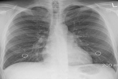 Sử dụng trí tuệ nhân tạo (AI) vào cuộc chiến chống ung thư do amiang