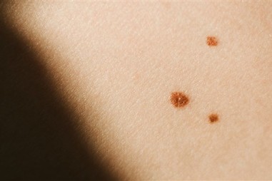 Mức testosterone cao ở nam giới có liên quan đến nguy cơ ung thư da