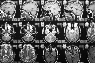 Thành tựu mới về điều trị ung thư não