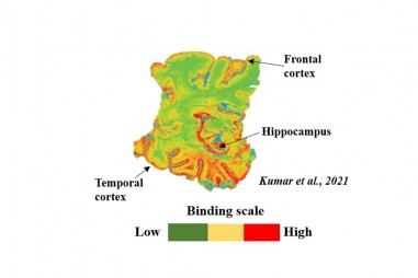Chất chỉ thị PET mới có thể được dùng để phát hiện sớm bệnh Alzheimer