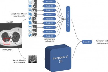 Chương trình AI dự đoán chính xác nguy cơ ung thư phổi