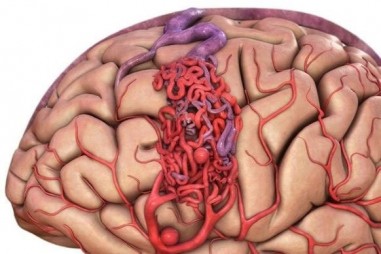Đột biến gene - nguyên nhân gây dị dạng mạch máu não thể hang