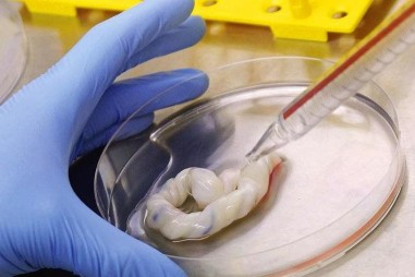 Tế bào gốc điều trị bệnh phổi tắc nghẽn mạn tính