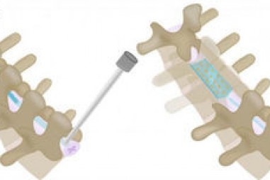 Thiết bị cấy ghép siêu mỏng điều trị đau lưng