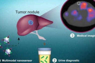 Sử dụng các hạt nano để phát hiện tế bào ung thư