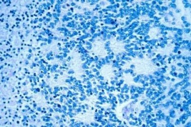 Đồng hồ phân tử có thể là chìa khóa để điều trị u nguyên bào thần kinh