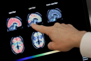 Thử nghiệm dùng trí tuệ nhân tạo chẩn đoán sớm chứng sa sút trí tuệ