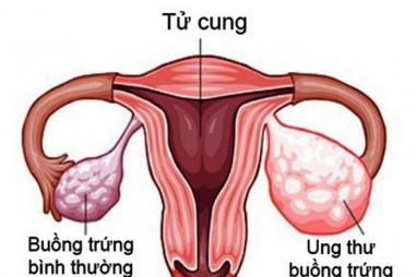 Học viện Quân y nghiên cứu điều trị ung thư buồng trứng bằng liệu pháp virus tiêu hủy u