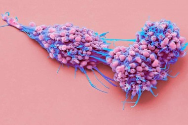 Bộ đôi thuốc giúp tăng hiệu quả điều trị ung thư buồng trứng ở hàng nghìn phụ nữ