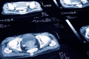 Xét nghiệm ung thư tuyến tiền liệt mới có thể tránh được các sinh thiết không cần thiết