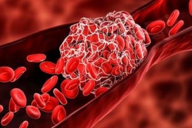 Thuốc giúp thoát khỏi bẫy của phản ứng miễn dịch gây tắc mạch