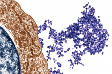 Tìm ra virus liên quan đến bệnh đa xơ cứng