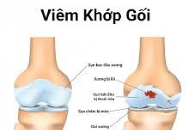 Sụn đột biến gen tạo ra thuốc chống viêm để đáp ứng với vận động của đầu gối