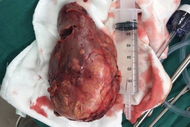 Phá hủy khối u bằng âm thanh